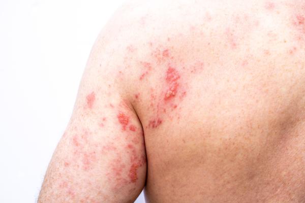 Elderly man with shingles rash on back and back of arm