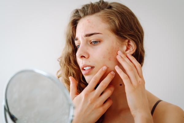 Young woman with acne