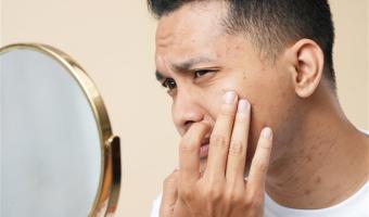 Asian man popping pimple on cheek while standing near mirror
