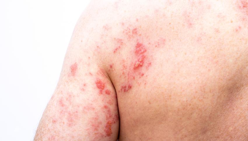 Elderly man with shingles rash on back and back of arm