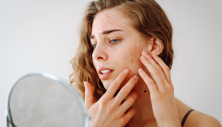 Young woman with acne