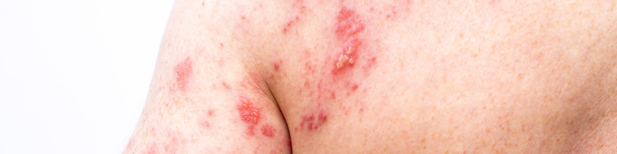 Elderly man with shingles rash on back and back of arm