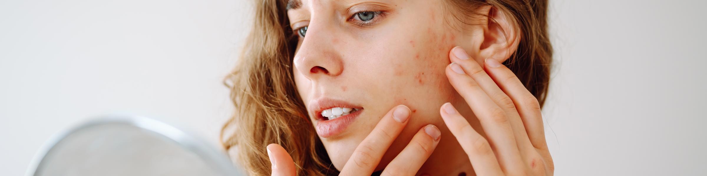 Young woman with acne